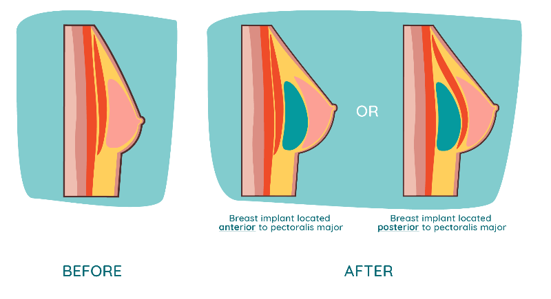 PHIN Breast enlargement surgery